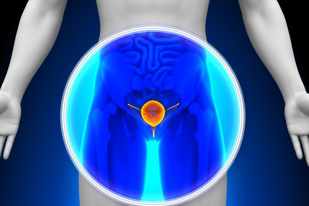 Bladder cancer