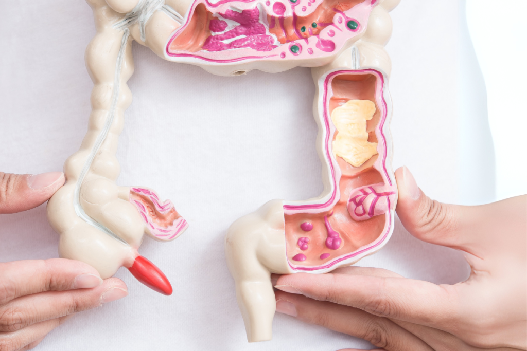 Colorectal cancer