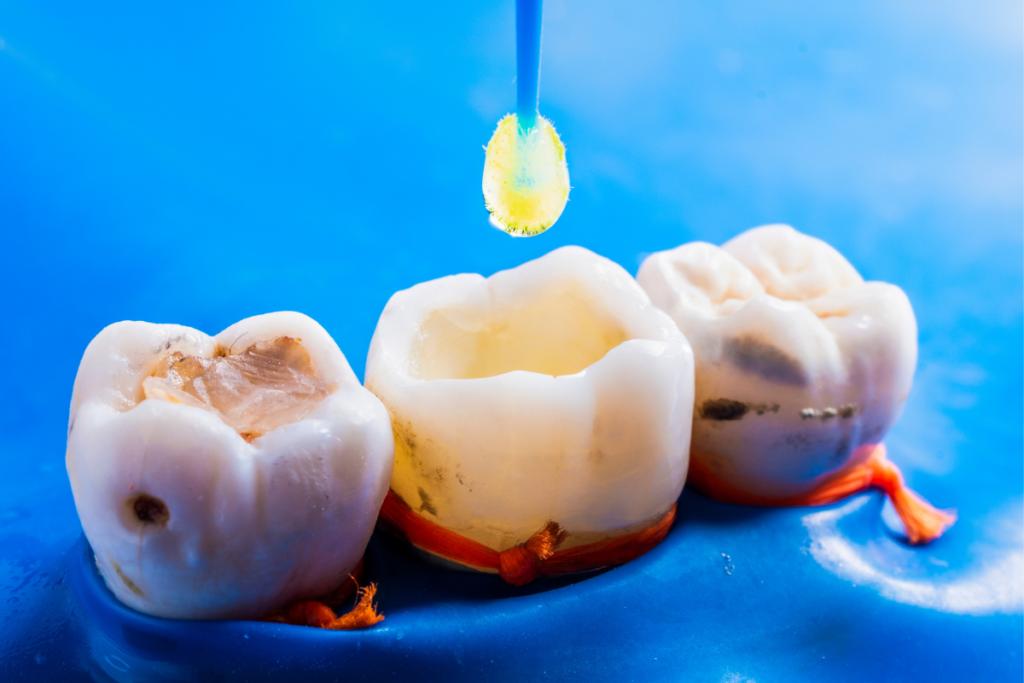 Dental fillings
