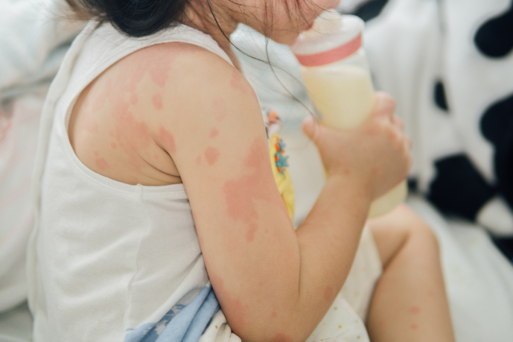 Eczema