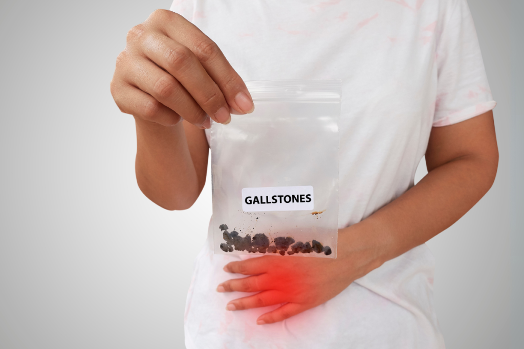 Gall stones
