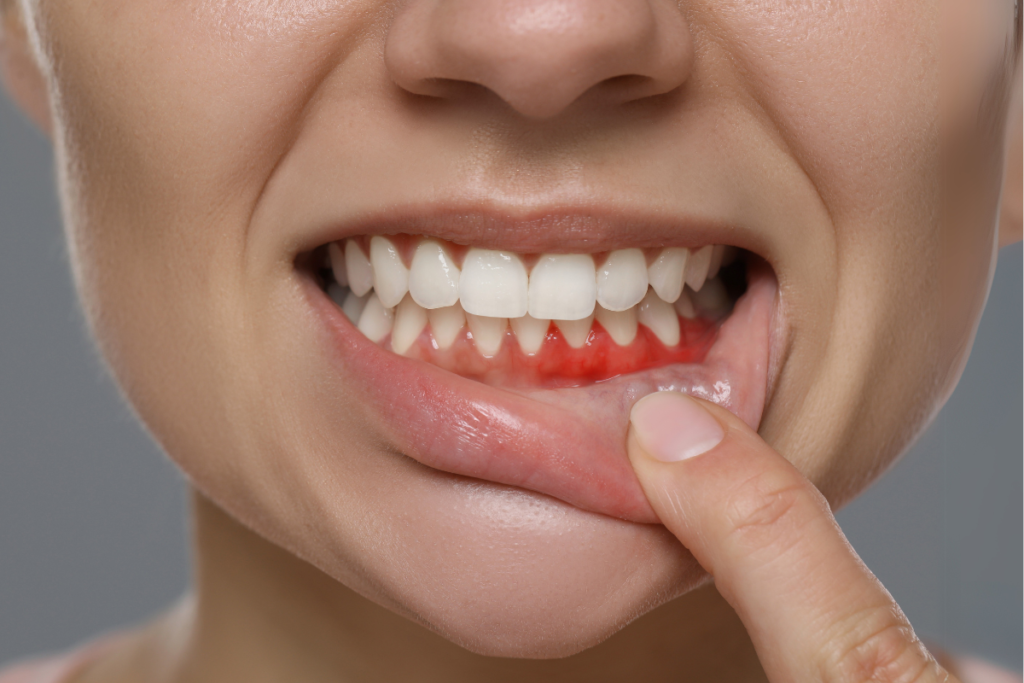 Gum Disease_ The Silent Threat Hiding in Your Mouth