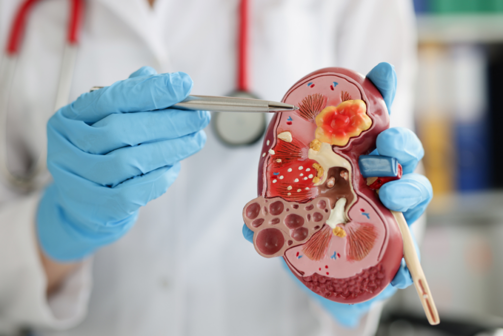 Nephrotic Syndrome