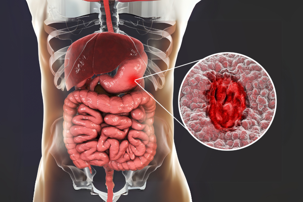 Peptic Ulcers