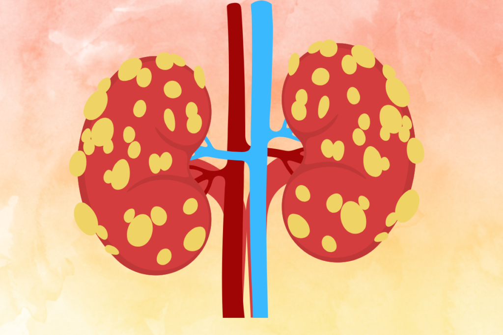Polycystic kidney disease