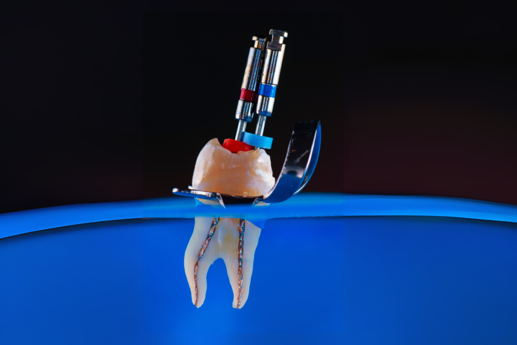 Root Canals_ What You Need to Know About This Common Procedure
