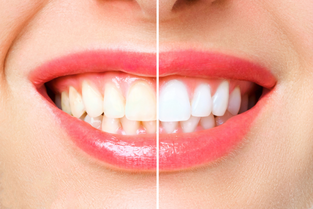 Whitening Woes_ Can You Trust Over-the-Counter Products