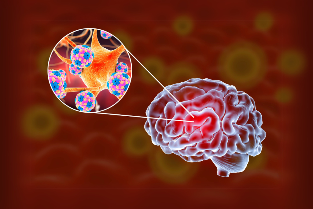 meningitis