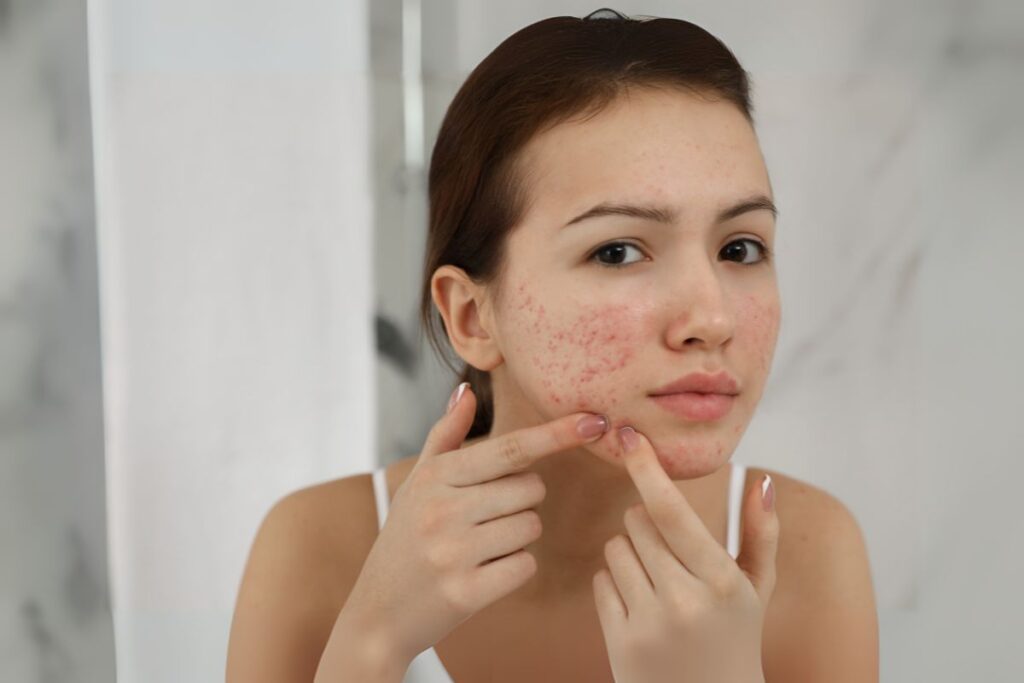 क्या आपके चेहरे पर लगातार मुंहासे (Acne) आ रहे हैं? ये 5 कारण हैं जिनसे आप अनजान हैं!