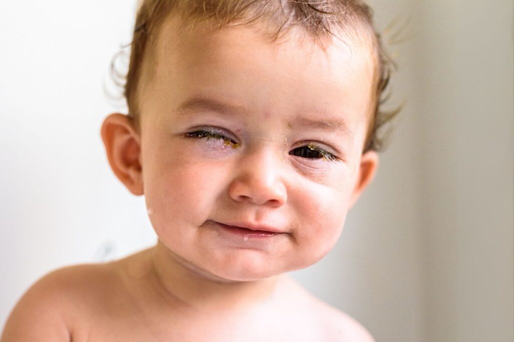 Pink eye: Is it allergy or conjunctivitis? Know the symptoms and solutions.