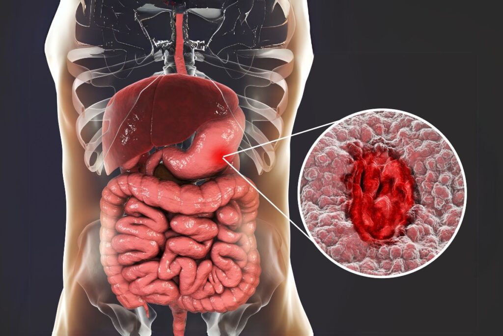 लगातार पेट दर्द, डायरिया और कमजोरी? हो सकता है IBD, तुरंत जांच करवाएं!
