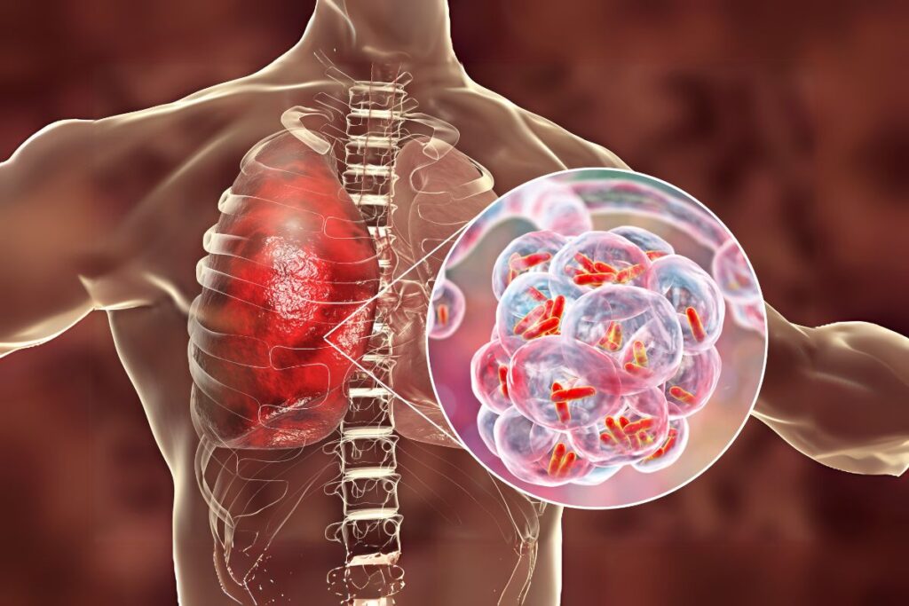A chest infection that can become life-threatening—what to look for in a patient with Pneumonia?