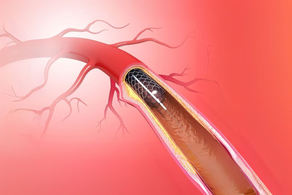 क्या Heart Attack के बाद स्टंट (stent) होता है ज़रूरी? जानिये हार्ट अटैक से जुड़े 10 सबसे बड़े मिथकों के पीछे का सच!