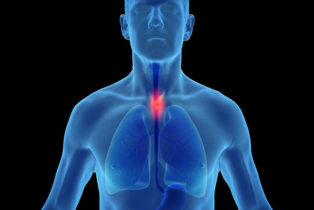 Esophageal Cancer: Symptoms, Screening, and Treatment You Should Know