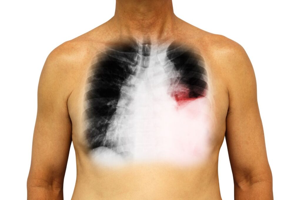 Lung Cancer: Early Symptoms, Screening, and Treatment You Need to Know