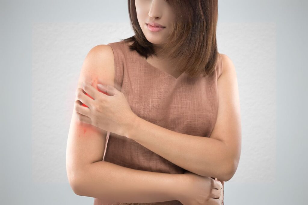 Psoriasis