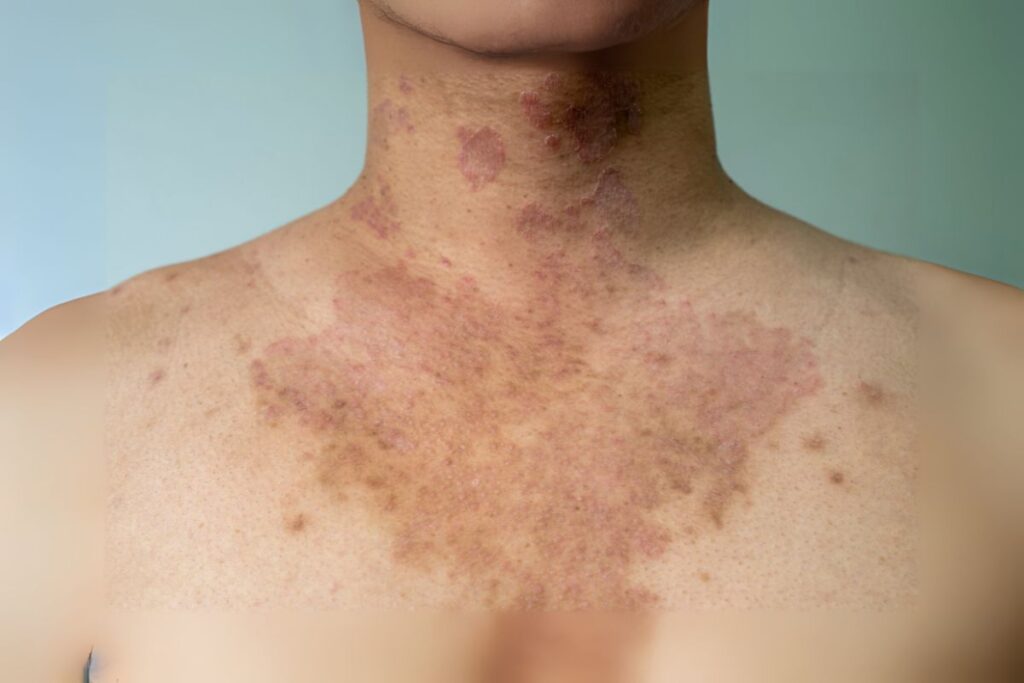Tinea/Ringworm