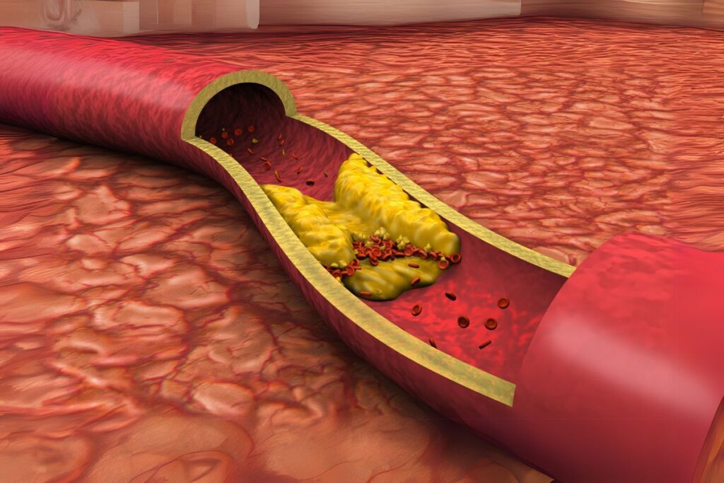 Is cholesterol really bad for your heart? Find out the truth about statins and heart disease.