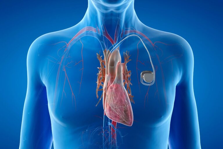 Spacemaker For Heart Pacemaker for Heart Rhythm Disorders: Types, Uses & Benefits