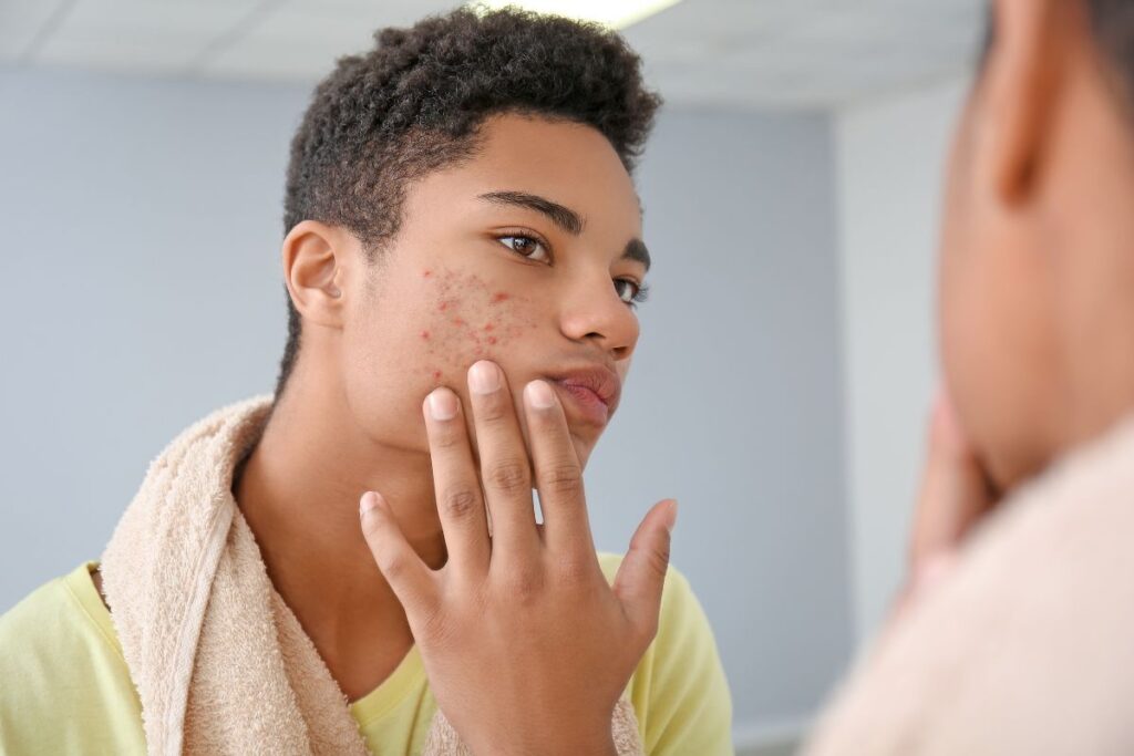 Acne in Teenagers: Can It Be Treated? Causes, Prevention, and How to Cure It!