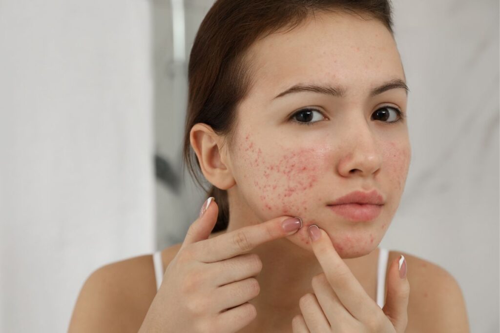 Is acne curable?" Discover the Truth Behind Acne Treatments and What Works!